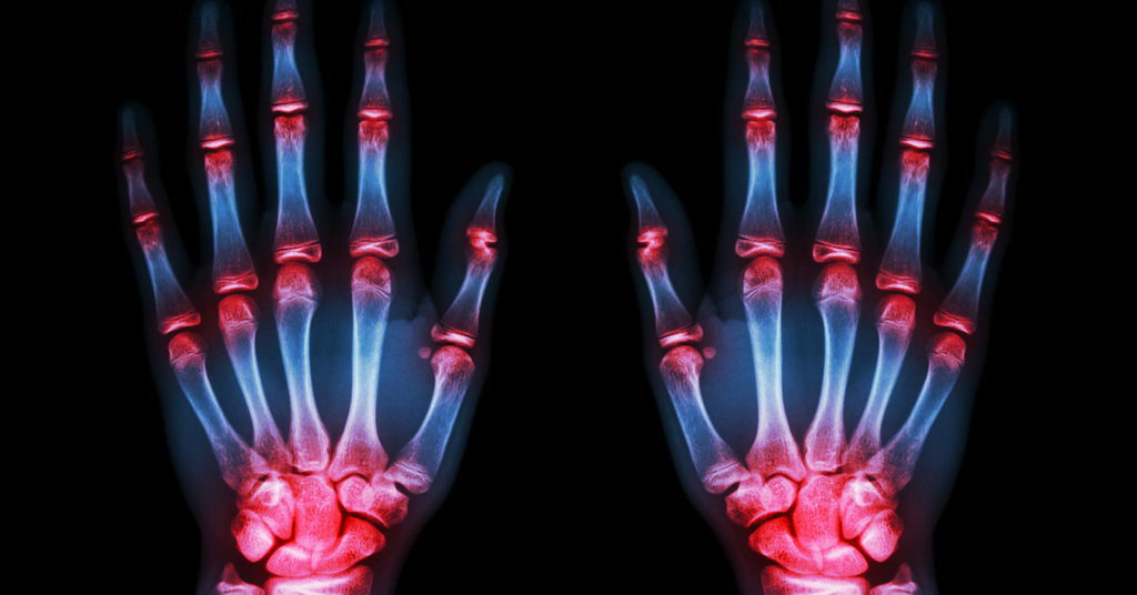 8 Things You Need To Know About Rheumatoid Arthritis
